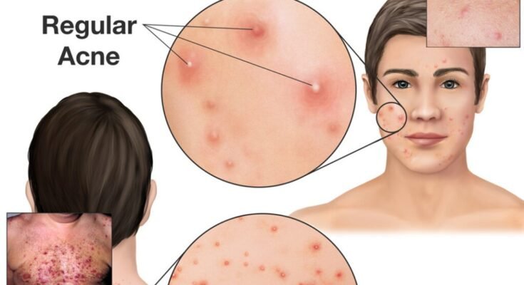 The Complete Truth About Acne Drugs