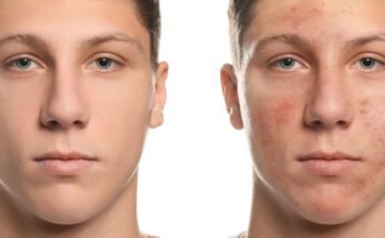 The Complete Truth About Acne in Teens Teen Acne: Causes and Solutions"