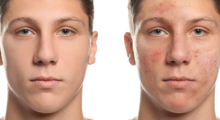 The Complete Truth About Acne in Teens Teen Acne: Causes and Solutions"