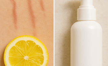 Medical Solutions to Fade Red Stretch Marks